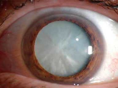 Cataract